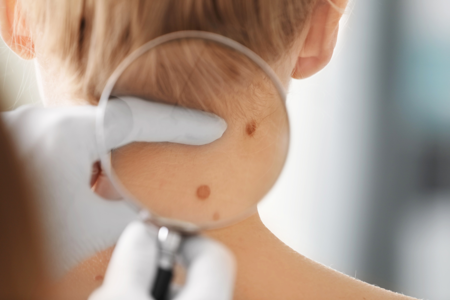 Causes and Stages of Melanoma