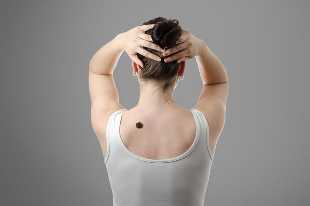 Early Signs of Skin Cancer