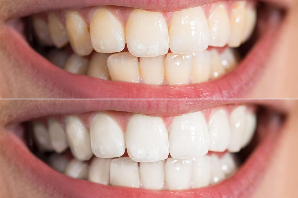 Most Popular Teeth Whitening Brands