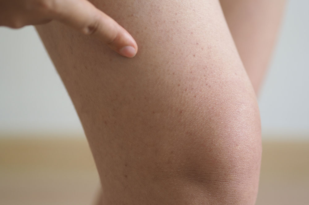 Tips to Manage Hemophilia